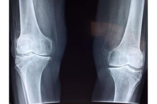 更新的指南介绍了关于全髋关节和膝关节药物使用的新建议