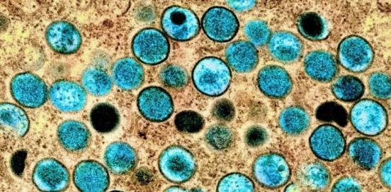 猴痘常见问题:如何传播?它是从哪里来的?有什么症状?天花疫苗能预防吗?